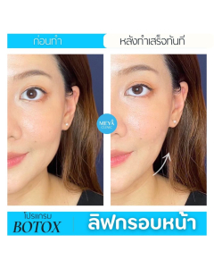 Meya Clinic Botox face lift