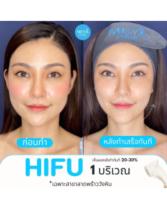 Meya Clinic Hifu 1 area (only Lat Phrao Wang Hin branch)